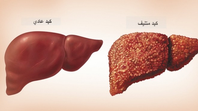 فيروس سي وعلاجه , تعرف على اعراض فيرس سى