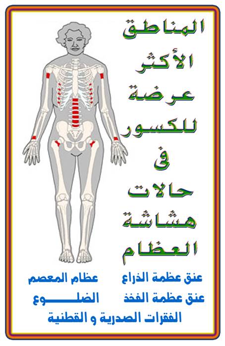 اسباب هشاشة العظام عند الرجال - هشاشة العظام اسبابها وعلاجها 7641 1