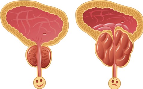 علاج تضخم البروستاتا , اشتكى من منطقة البروستاتا