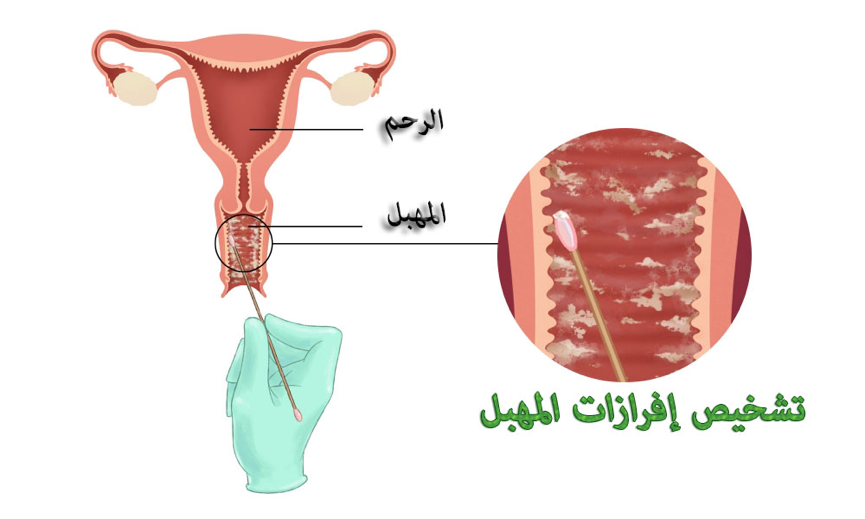 ريحه كريهه من المهبل - وداعا لرائحة المهبل الكريهه 8556