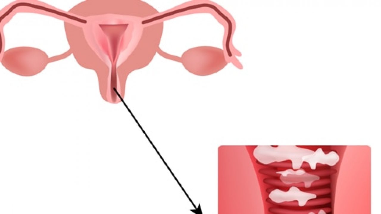 ريحه كريهه من المهبل - وداعا لرائحة المهبل الكريهه 8556 6