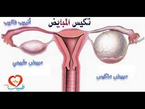 ماهي اعراض تكيس المبايض - علاج تكييس المبايض 2839 2