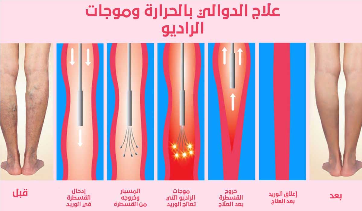 علاج الدوالي , الليزر او التصليب لعلاج دوالي الساقين