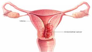 اعراض سرطان الرحم , كيف نعرف ان الشخص مصاب بسرطان الرحم