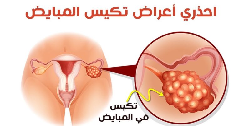 أنسب طريقة للتخلص من تكيسات المبايض - علاج التكيس 5185 1