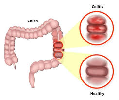 اعراض التهاب القولون - القولون مرض العصر واعراضه وطريقة علاجه 972 9