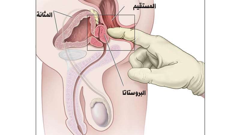 اعراض البروستاتا , ماهو مرض البورستاتا