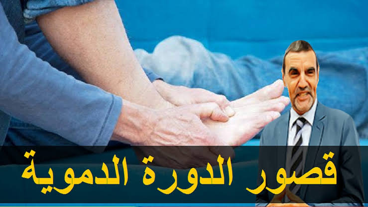 علاج قصور الدورة الدموية - مؤشرات ضعف الدورة الدموية 7840 4