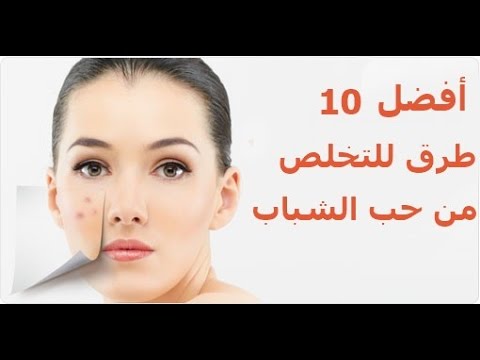 طريقة التخلص من حب الشباب - تخلصي من الحبوب بالوصفة دى رهيييبة 6155 2