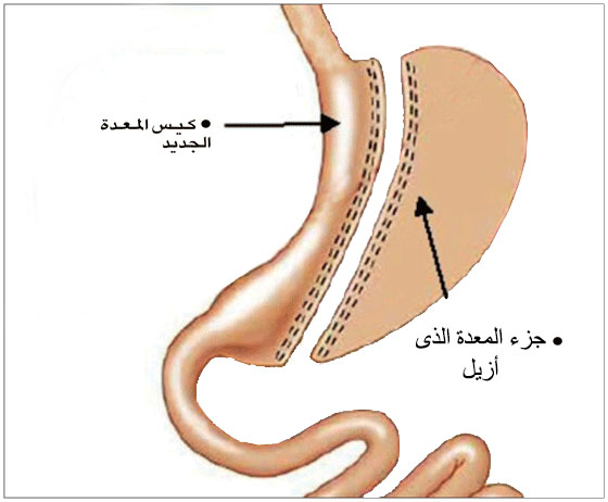 الاكل بعد عملية التكميم - التكميم والنظام الغذائى 7704 9