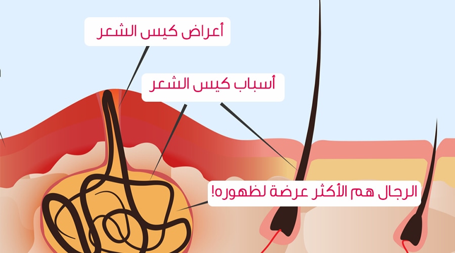 علاج كيس الشعر بدون جراحة , كيس الشعر مؤلم اعالجه ازاى