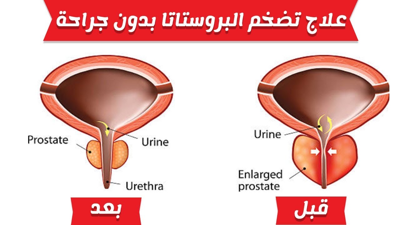 علاج تضخم البروستاتا - اشتكى من منطقة البروستاتا 6544 2