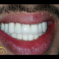 2179 3-Jpg خلطات تبيض الاسنان - وصفات طبيعية لتبييض الاسنان كميلة محمود